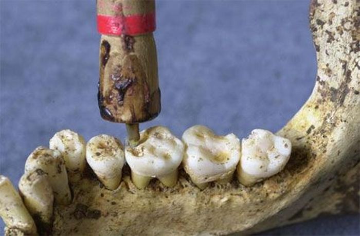 Инструменты стоматологов прошлого (15 фото)