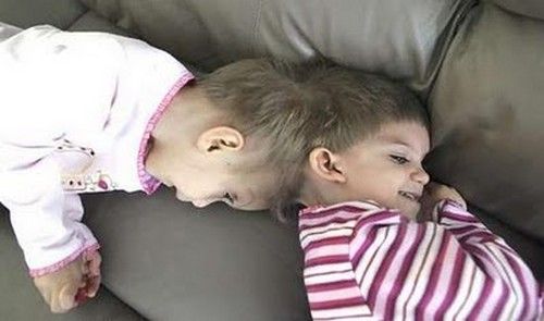 Ужасные фото сиамских близнецов (13 фото)