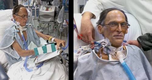 Первый в мире человек без сердца и пульса (4 фото)