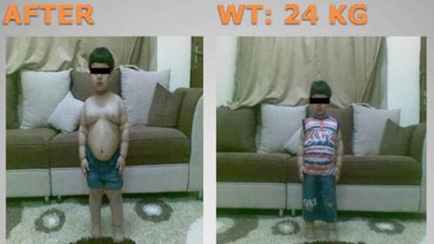 Двухлетний мальчик — самый молодой пациент, которому сделали операцию по уменьшению веса