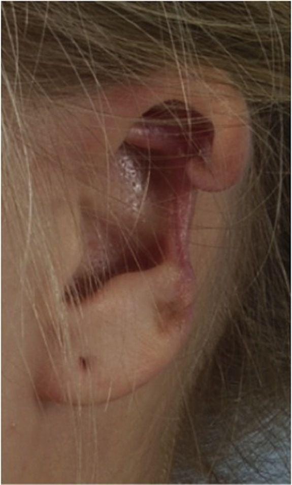 Итальянский паучок оставил девушку без уха (3 фото)