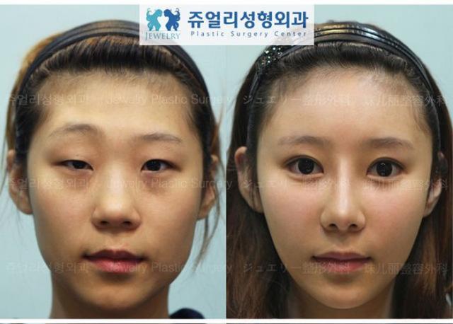 До и после пластической операции (60 фото)
