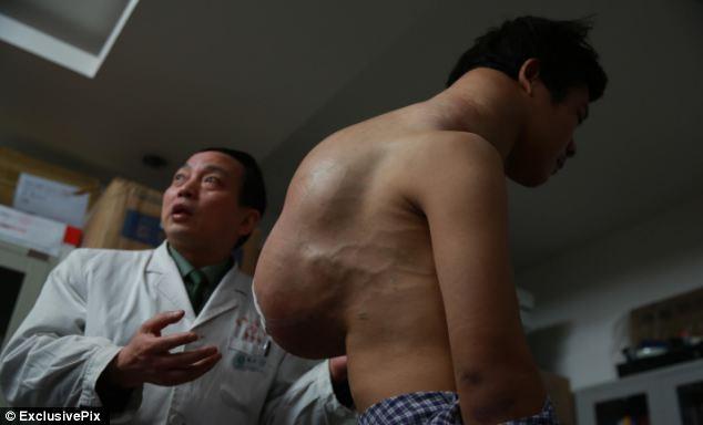 Хирурги срезали со спины китайца 10-килограммовый 'рюкзак' (5 фото)