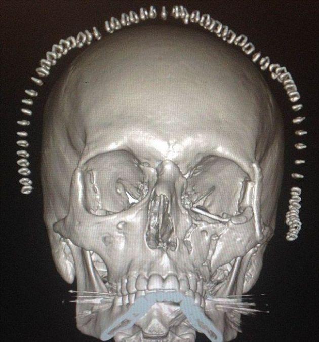 Необычная операция на черепе жертвы аварии (5 фото)