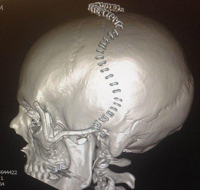 Необычная операция на черепе жертвы аварии (5 фото)
