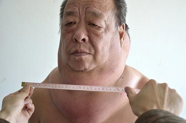 Китаец вынужден жить с огромной опухолью вокруг шеи (4 фото)