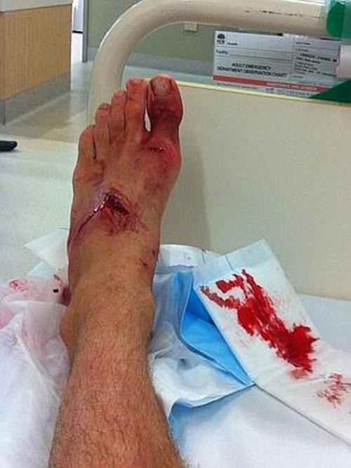 Австралиец голыми руками отбился от напавшей на него акулы (5 фото)