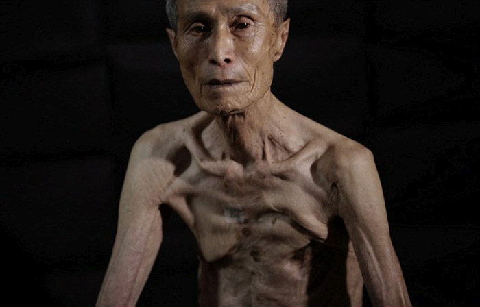 Последствия ядерного удара по Нагасаки на теле  пенсионера (10 фото)