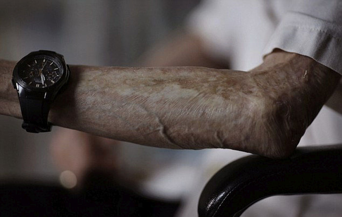 Последствия ядерного удара по Нагасаки на теле  пенсионера (10 фото)