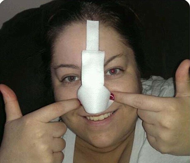 После пересадки кожи девушка вынуждена брить нос (10 фото)