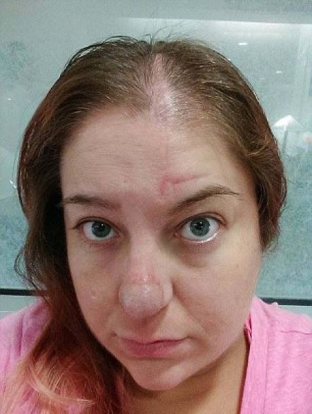 После пересадки кожи девушка вынуждена брить нос (10 фото)