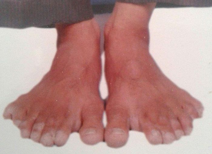 Девендра Сутхар - рекордсмен мира по количеству пальцев (7 фото)