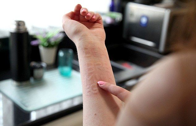 Девушка с сыпью использует собственную кожу в качестве шпаргалки (4 фото)