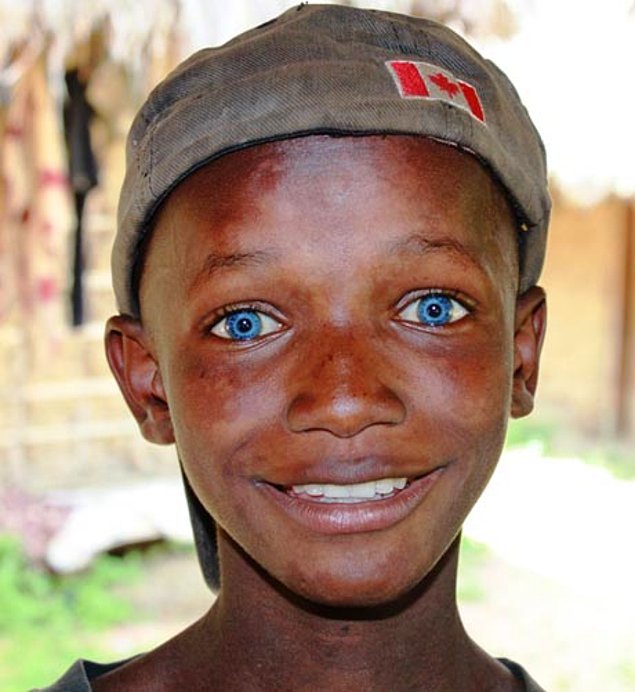 Африканские дети с голубыми глазами (16 фото)
