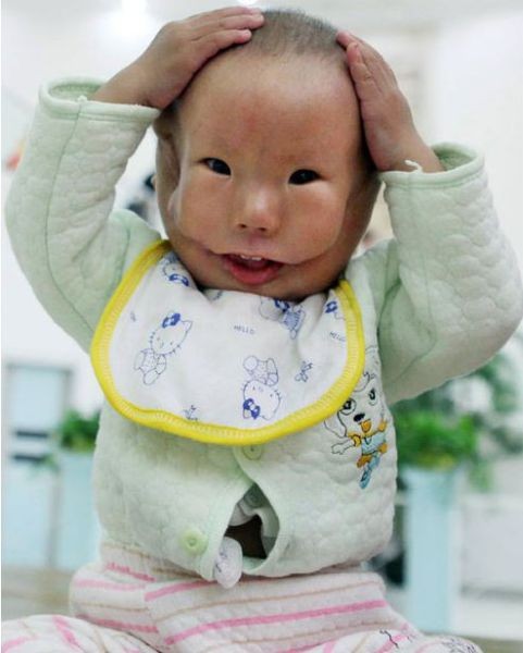 Ребенок с лицом-маской (6 фото)