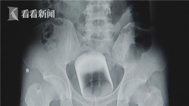 Пациент отказался объяснять врачам, откуда в его заднице взялся стакан (3 фото)