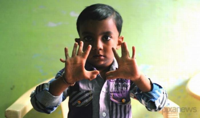 4-летний мальчик с 25 пальцами (4 фото)