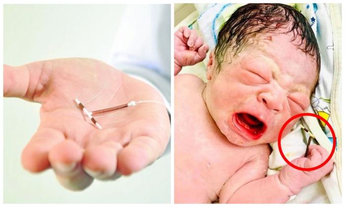 Родился малыш,который держал в руках противозачаточную спираль(3 фото)