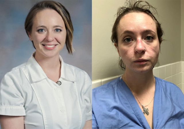 Медсестра Кэтрин Айви показала, как ее лицо изменила работа (6 фото)