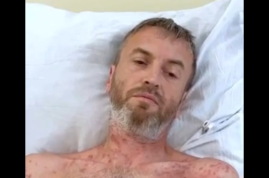 Первую жертву борщевика в этом году спасли московские врачи (видео)